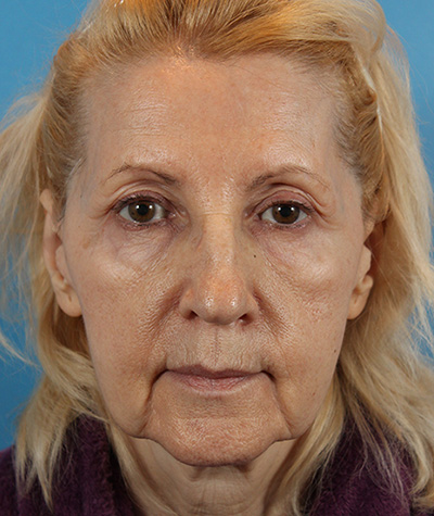 Brow Lift Before Photo #1