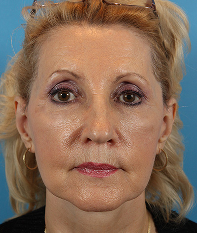 Brow Lift After Photo #2