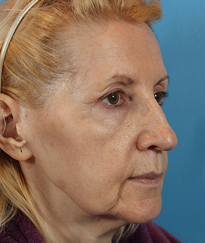 Brow Lift Before Photo #3