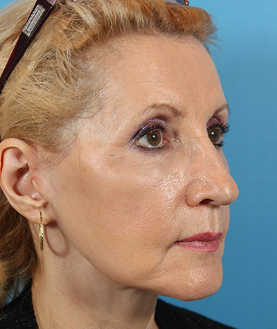 Brow Lift After Photo #4