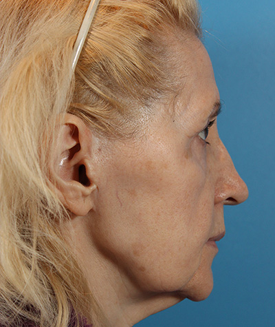 Brow Lift Before Photo #5