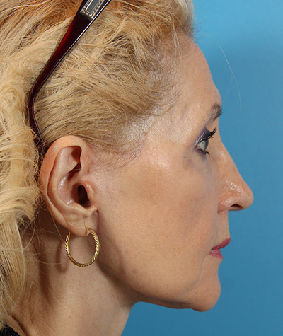 Brow Lift After Photo #6