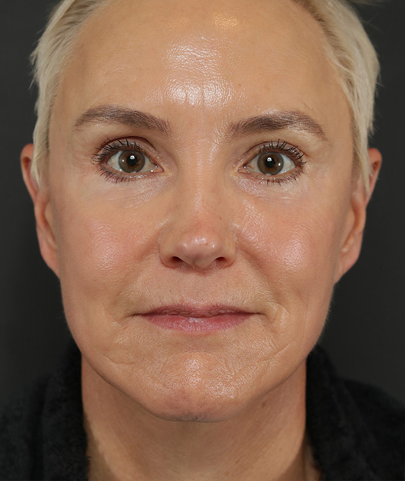 Eyelid Surgery After Photo #2