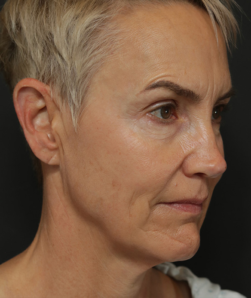 Eyelid Surgery Before Photo #3