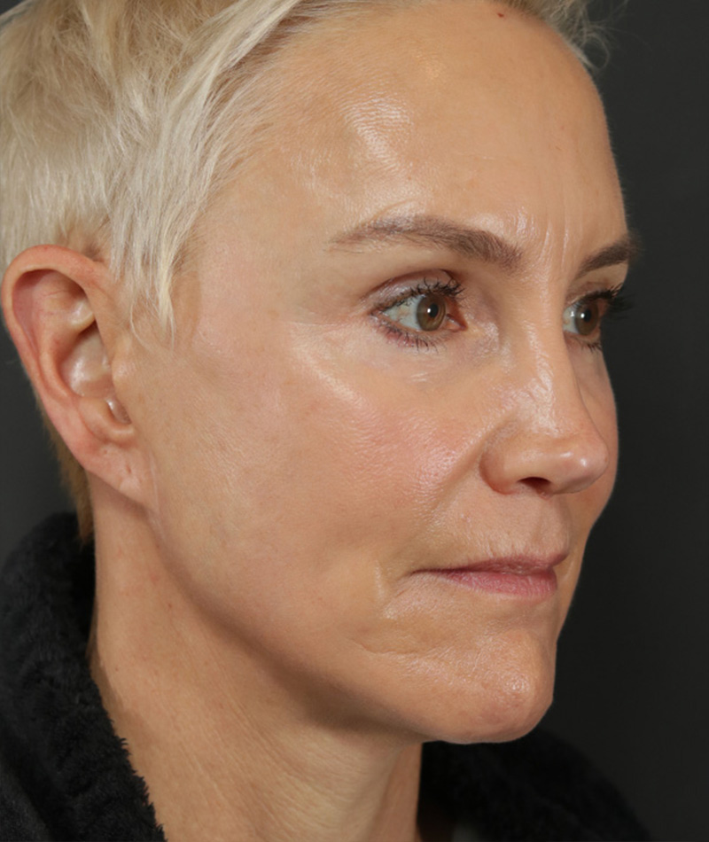 Eyelid Surgery After Photo #4
