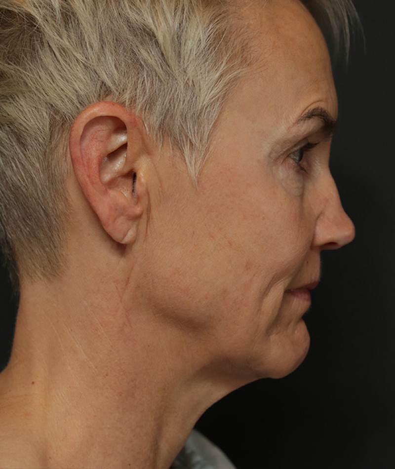 Eyelid Surgery Before Photo #5