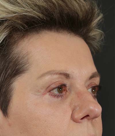 Eyelid Surgery After Photo #2