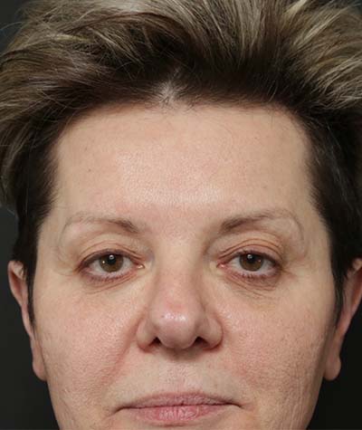 Eyelid Surgery Before Photo #3