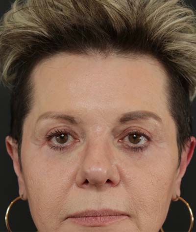 Eyelid Surgery After Photo #4