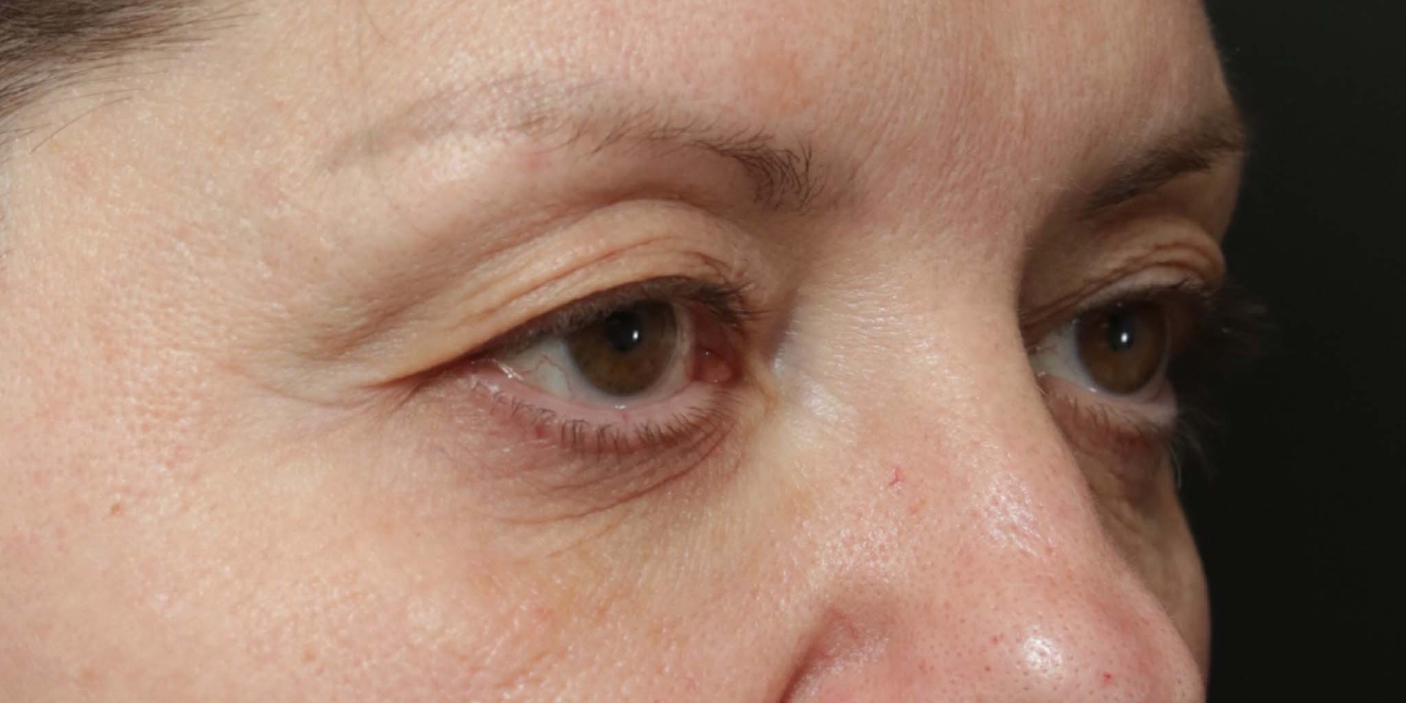 Eyelid Surgery Before Photo #5