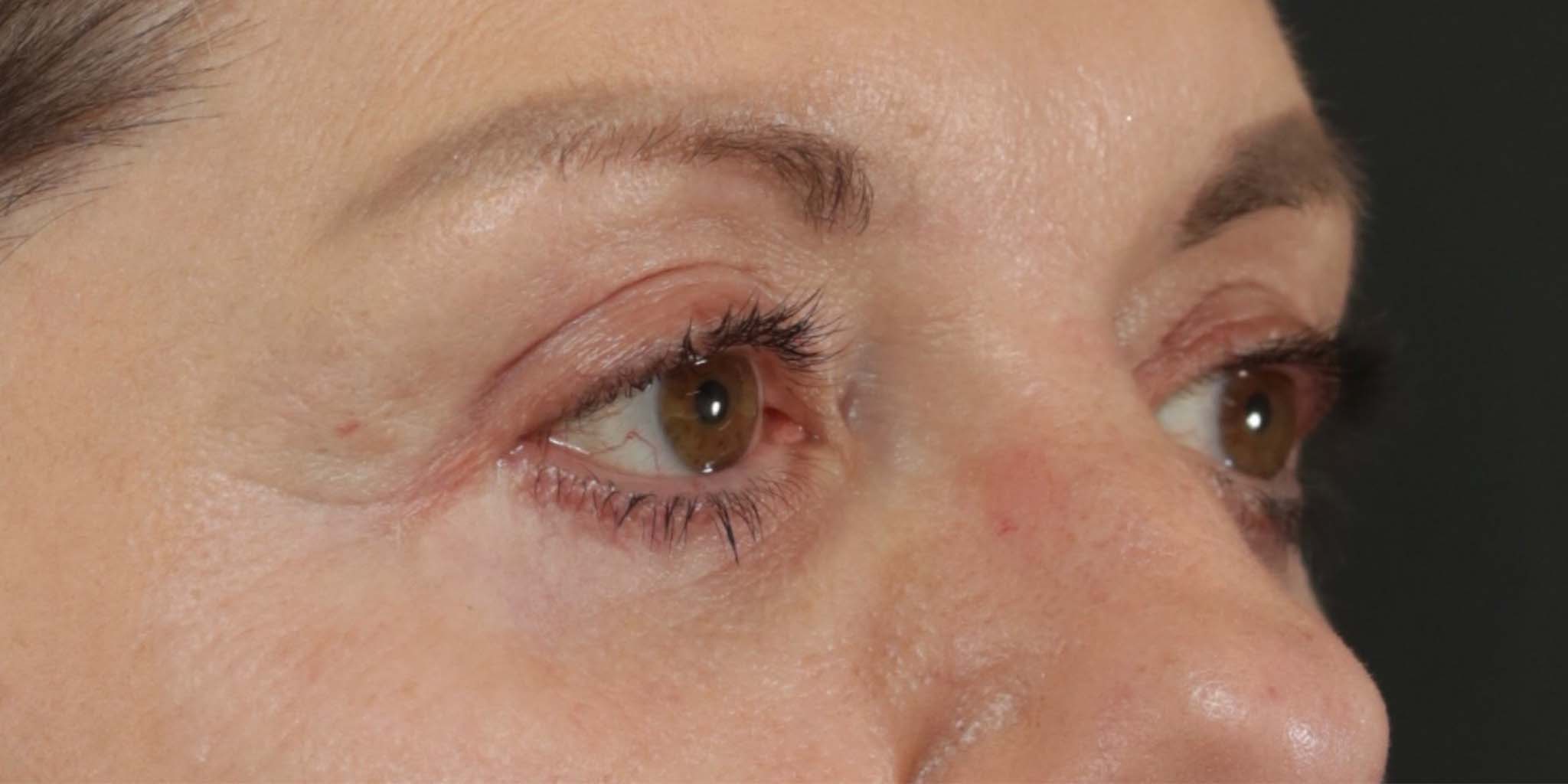 Eyelid Surgery After Photo #6