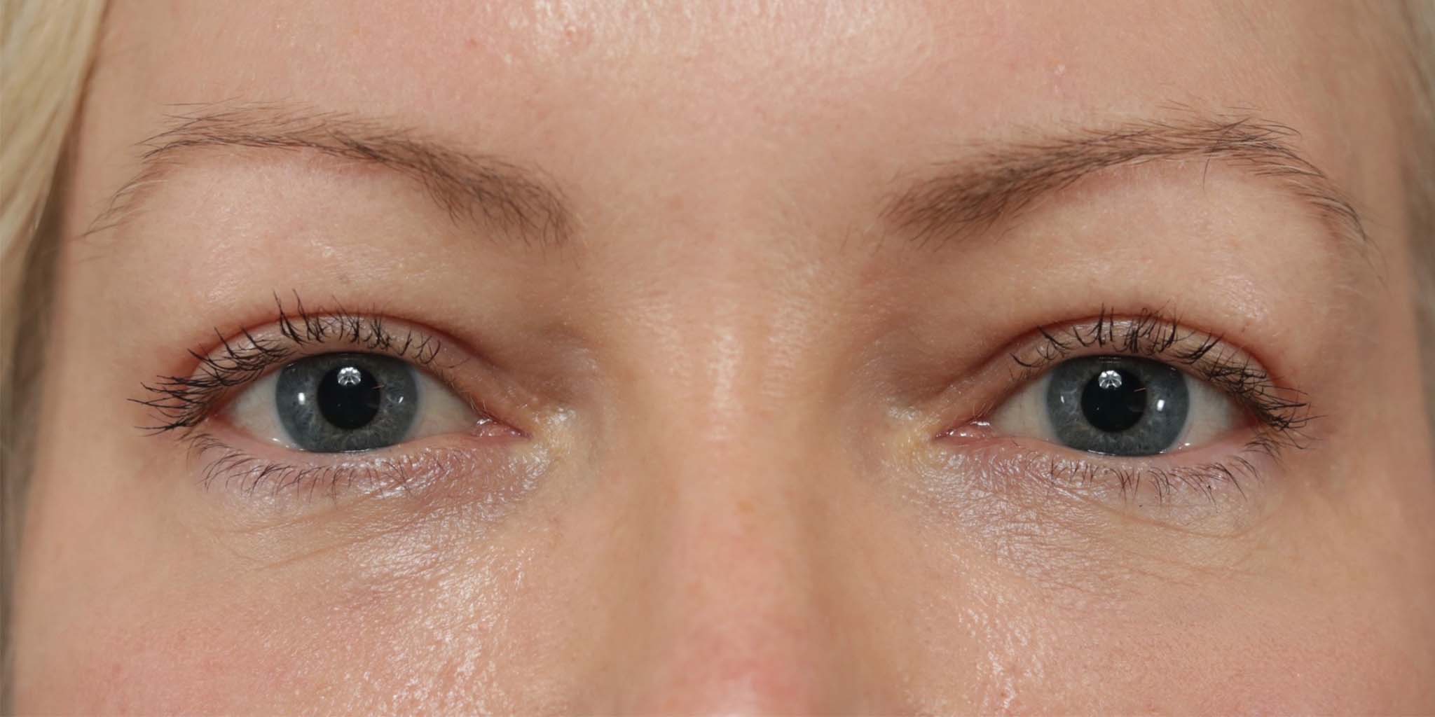 Eyelid Surgery After Photo #2