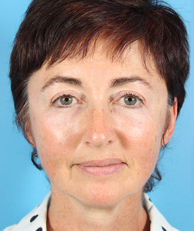 Eyelid Surgery After Photo #2
