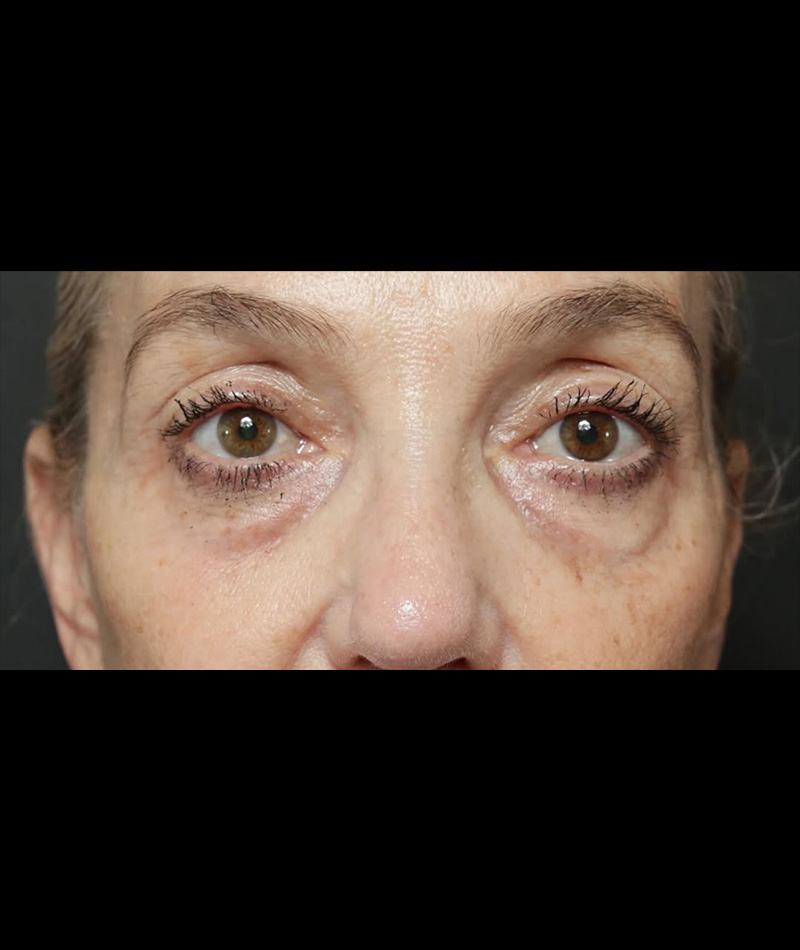 Facelift Before Photo #7