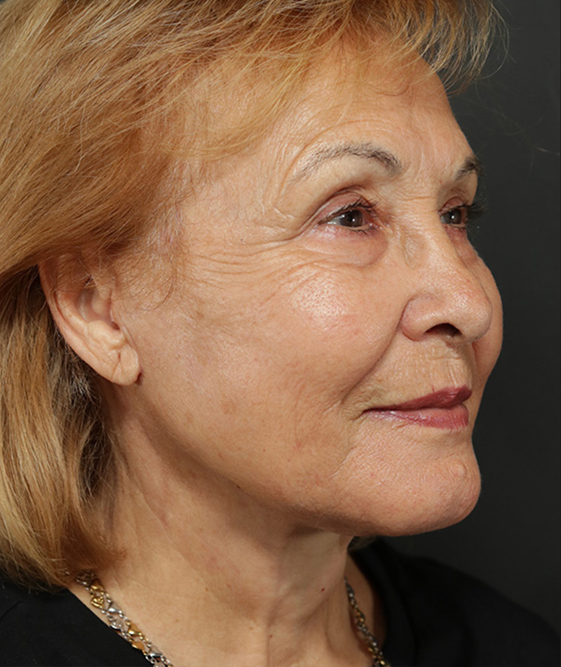 Facelift After Photo #4