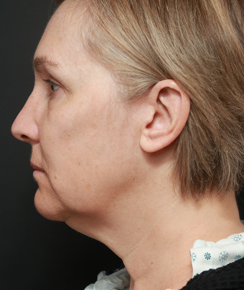 Facelift Before Photo #5