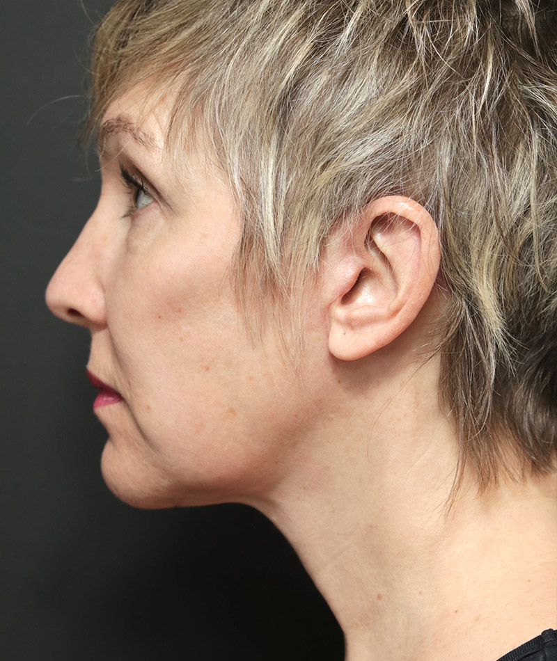 Facelift After Photo #6