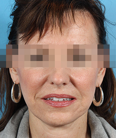 Facelift After Photo #2