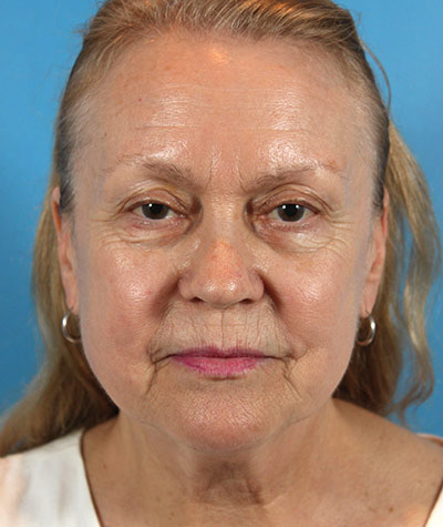 Facelift Before Photo #1