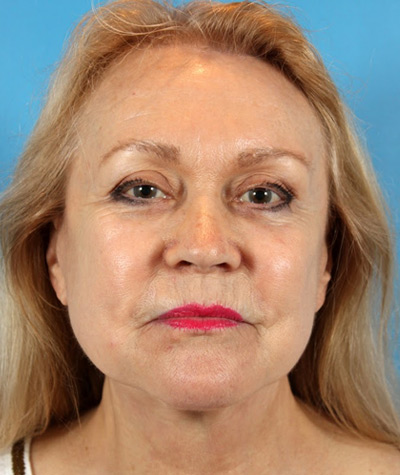 Facelift After Photo #2