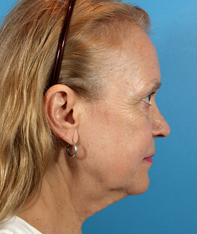 Facelift Before Photo #3