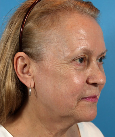 Facelift Before Photo #5