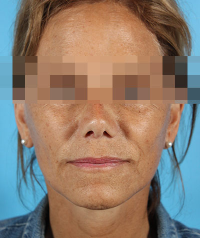 Facelift After Photo #2