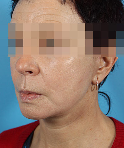 Facelift After Photo #2