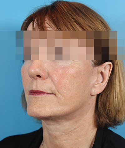 Facelift After Photo #2