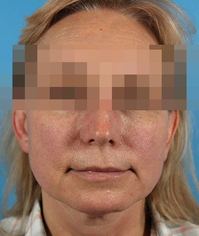 Facelift Before Photo #1