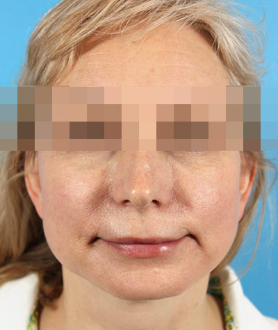 Facelift After Photo #2
