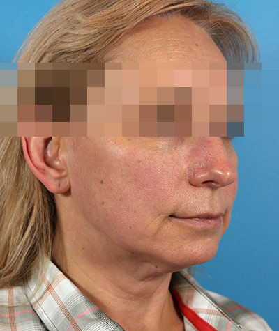 Facelift Before Photo #3