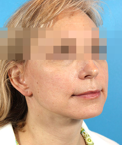 Facelift After Photo #4