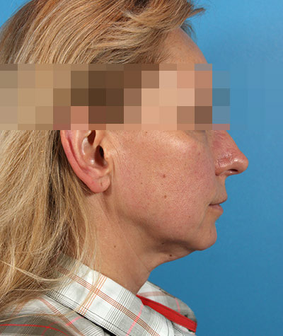Facelift Before Photo #5