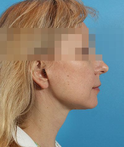 Facelift After Photo #6