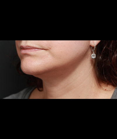 Facelift After Photo #2