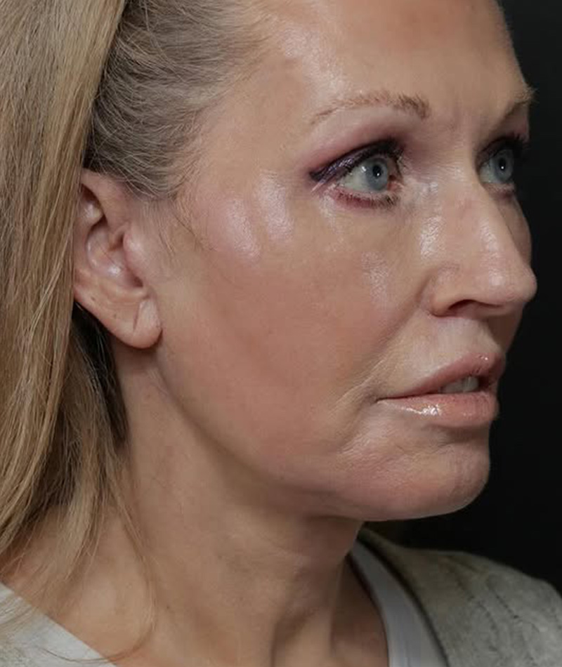 Neck Lift After Photo #2