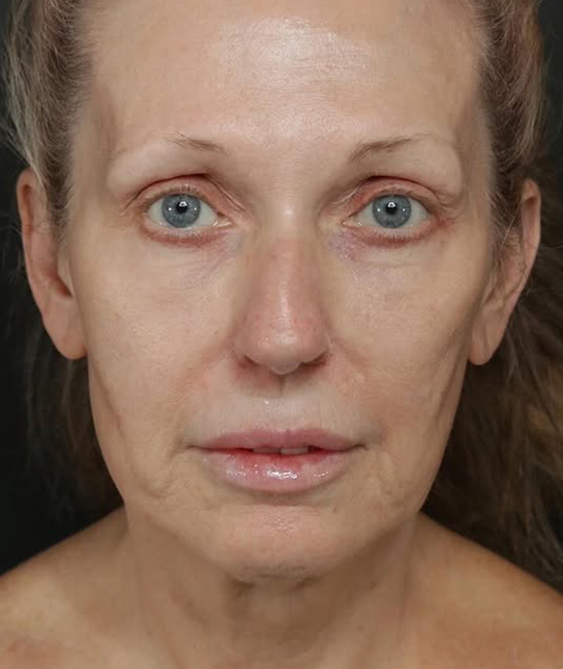 Neck Lift Before Photo #3