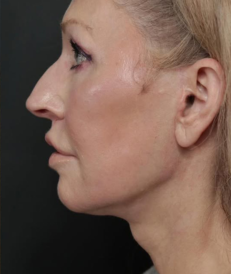 Neck Lift After Photo #6