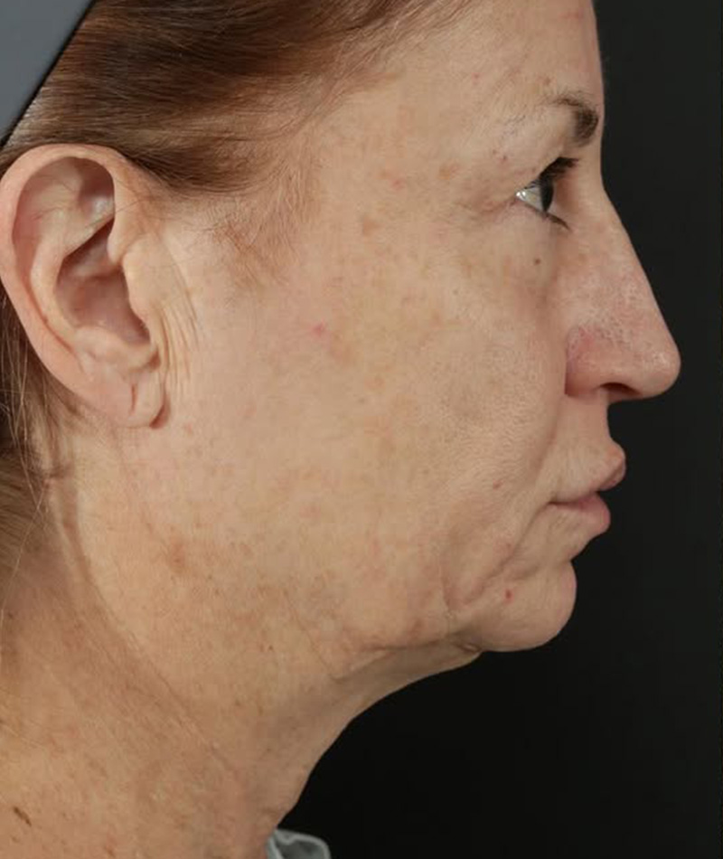 Neck Lift Before Photo #1