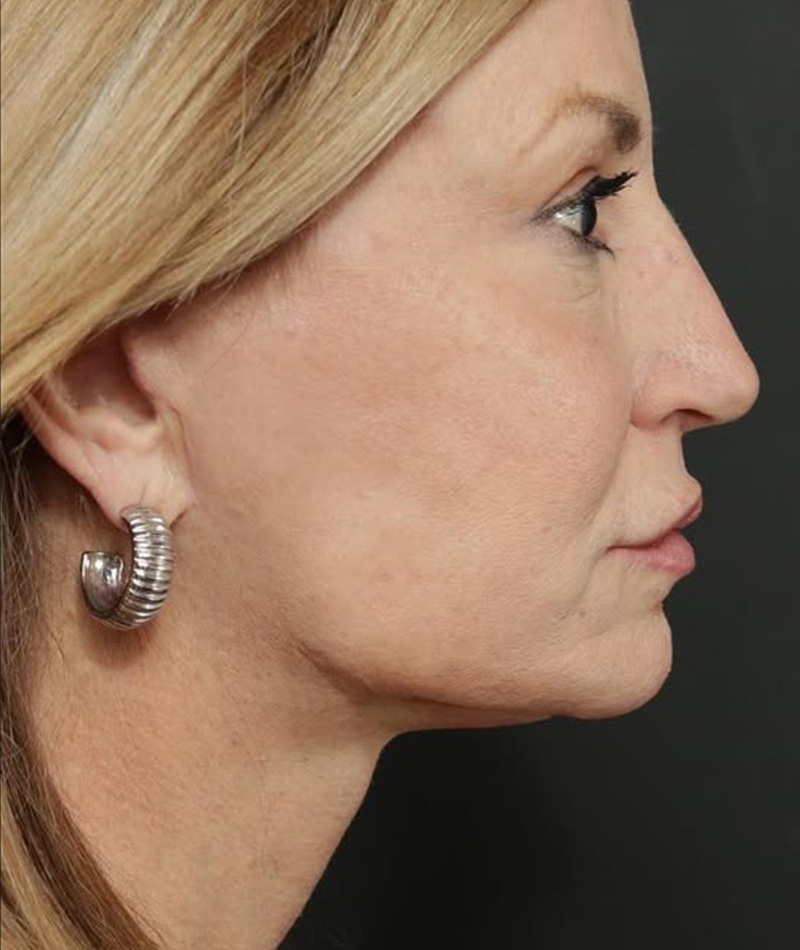 Neck Lift After Photo #2