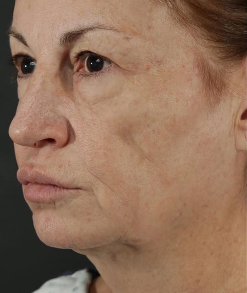 Neck Lift Before Photo #3