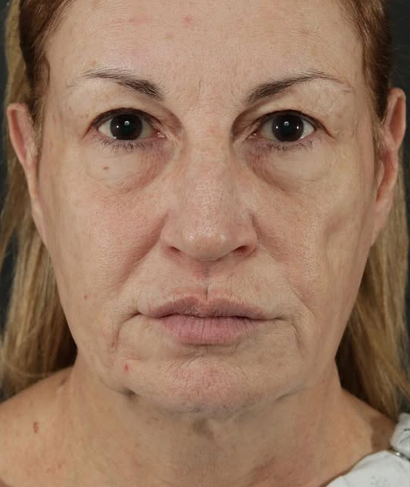 Neck Lift Before Photo #5