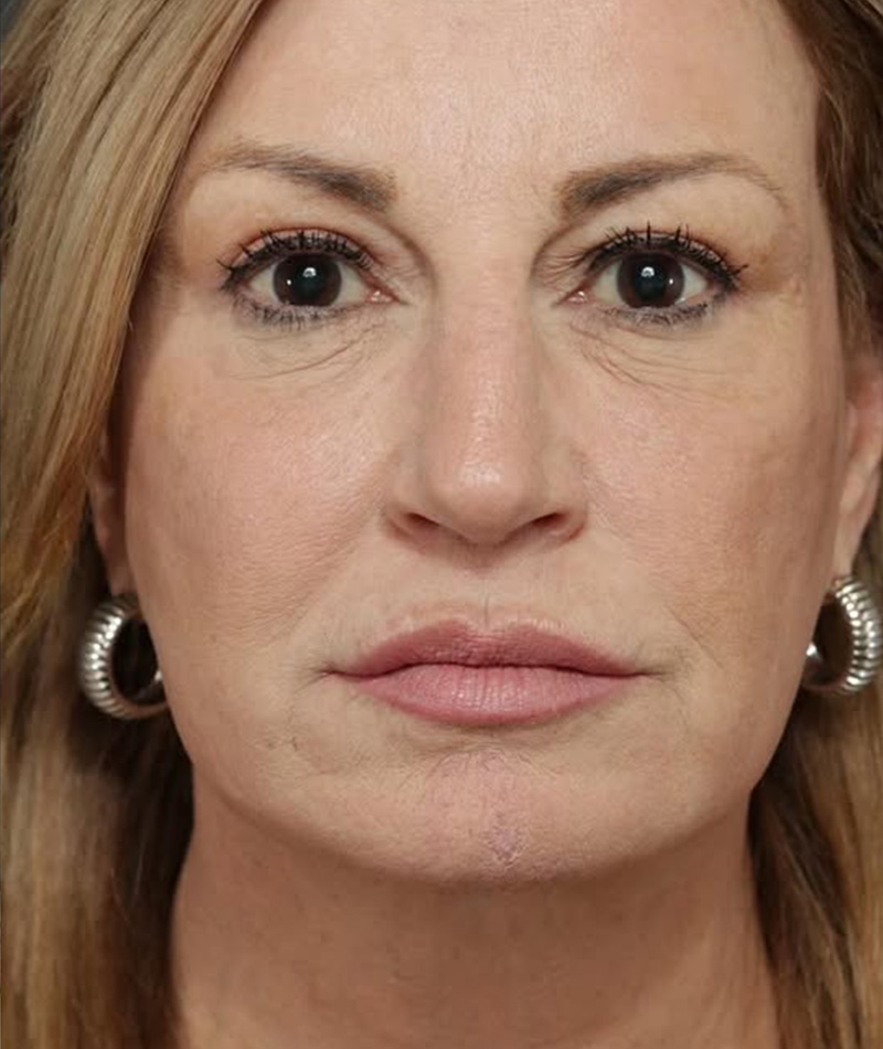 Neck Lift After Photo #6