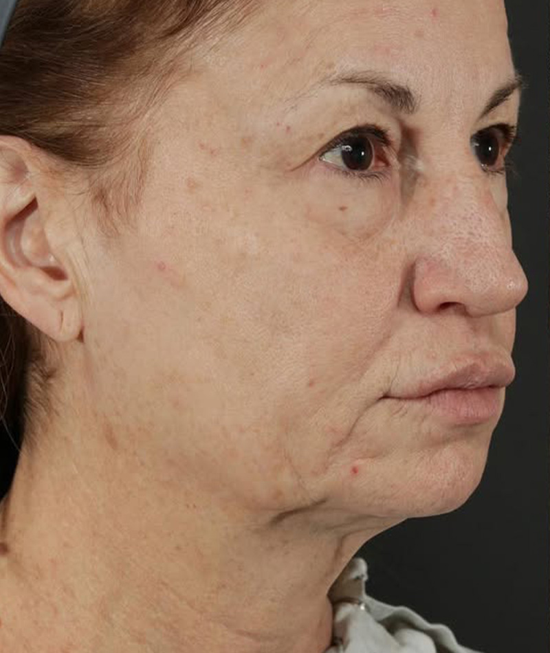 Neck Lift Before Photo #7