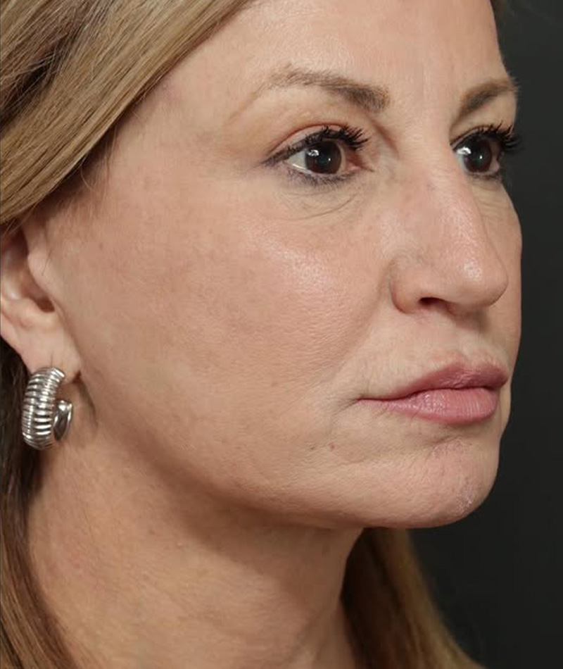 Neck Lift After Photo #8