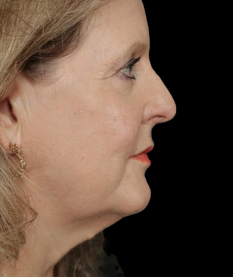 Neck Lift Before Photo #1