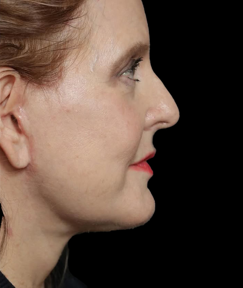 Neck Lift After Photo #2