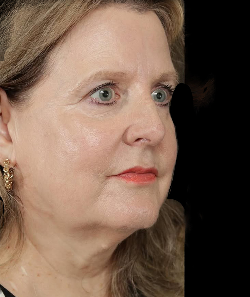 Neck Lift Before Photo #3