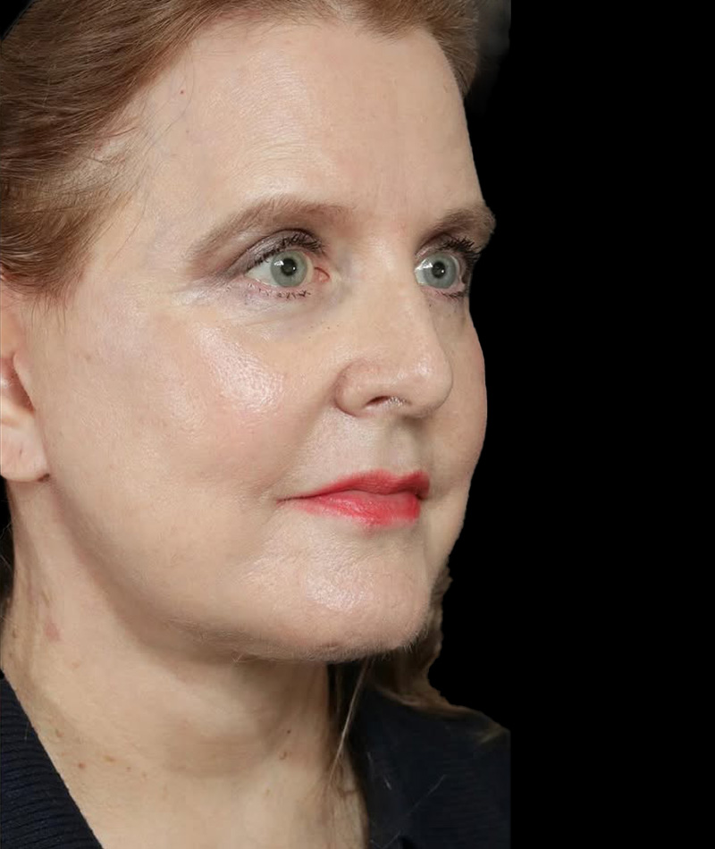 Neck Lift After Photo #4